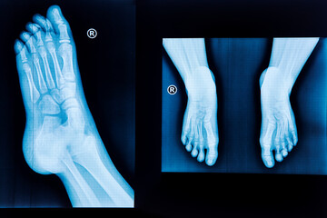 X-ray of human foot and pair of feet from different views