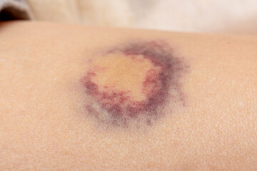 Fototapeta premium Hematoma on a woman's body as a result of violence