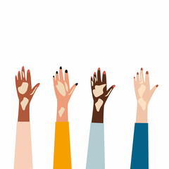 Female hands of different ethnic group with vitiligo skin. Skin hands with vitiligo depigmantation. Vitiligo awareness.Vector illustration