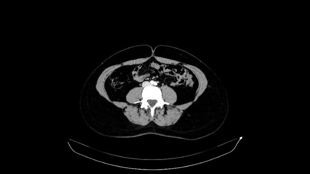 CT Of The Abdomen And Pelvis With Intravenous Contrast Of A 40-years-old Woman. Axial View. Arterial Phase.