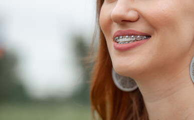 The smile of a young and beautiful girl with braces on her white teeth. Straightening of crooked teeth with the help of a bracket system. Malocclusion. Dental care. Smooth teeth and a beautiful smile