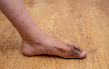 Swollen injured male limb on the left foot with hematoma when a heavy object falls on the leg