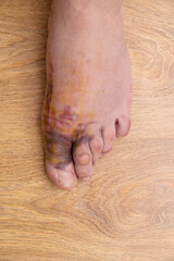Swollen injured male limb on the left foot with hematoma when a heavy object falls on the leg