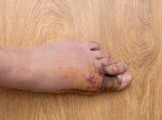 Naklejka premium Swollen injured male limb on the left foot with hematoma when a heavy object falls on the leg