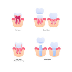 Tooth filling and implant chart. Vector biomedical illustration. Cross section. Filled teeth and prosthesis implantation steps isolated on white background. Design for dental oral healthcare