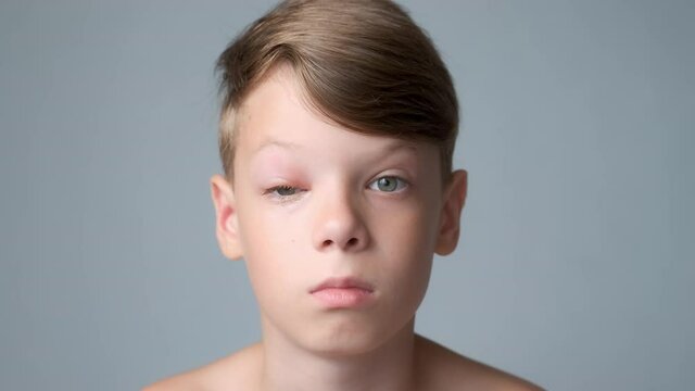 Portrait of a boy with a swollen eye from an insect bite. Allergic reaction to insect bites. Closed red sick eye of a teen boy. Eye disease in a child, conjunctivitis, inflammation in the eye.