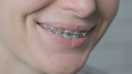Smile in braces of woman in braces close up. Happy female smile with dental metal braces system on teeth on white background. Orthodontic treatment. Dental health care