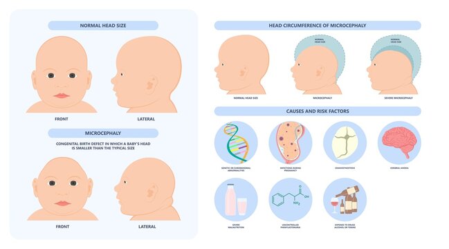 flat head syndrome