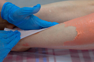 Epilation on the legs..Removal of unwanted hair on the legs.The master removes the wax with the help of special bandage strips for depilation.Orange wax is applied to the legs.
