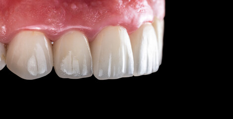 press ceramic crowns and veneers