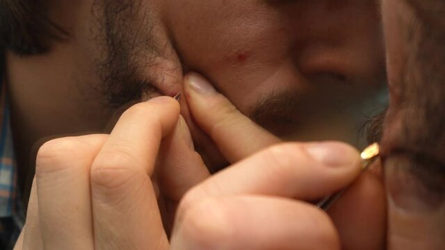 Macro Shot, A Man pluck a Hair with a tweezers on hs bloody skin - static shot