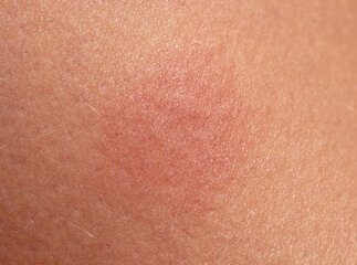 A wound on the skin of a person.