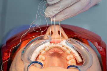 placing the fixed retainer in Process of removing dental braces from a Caucasian girl in a dental...