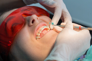 Fototapeta premium removing the elastics from the dental braces in process of removing dental braces from a Caucasian girl in a dental clinic with a female dentist
