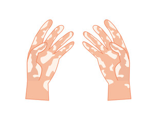 白斑の手のひら