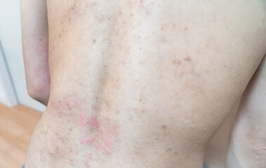 アトピー / あせも / 皮膚炎のイメージ。　肌荒れ男性の写真。