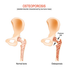 Osteoporosis. normal hip joint and bone with low bone mass. - obrazy, fototapety, plakaty