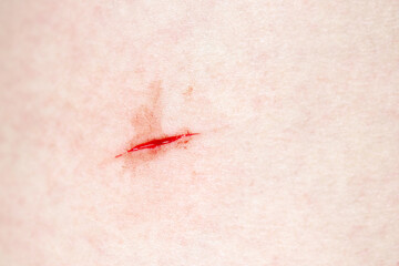 Cut on the body. Fresh wound on the leg with blood, skin texture. Woman's leg, red scratch is bleeding, first aid