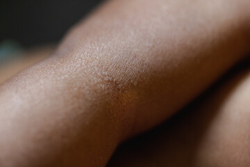 Close up of mild eczema on Black skin, newborn, dermatologist 