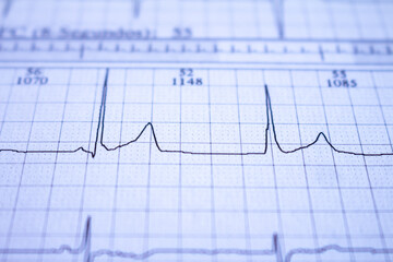 Close-up view of heartbeat with arrhythmia. Abnormal heartbeat.