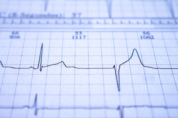 Close-up view of heartbeat with arrhythmia.Cardiovascular disease