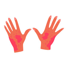Flat illustration of rashes and red spots on the skin of the hands. Various skin problems, such as allergies, psoriasis, itching, atopic dermatitis, eczema, dryness, redness. White background.