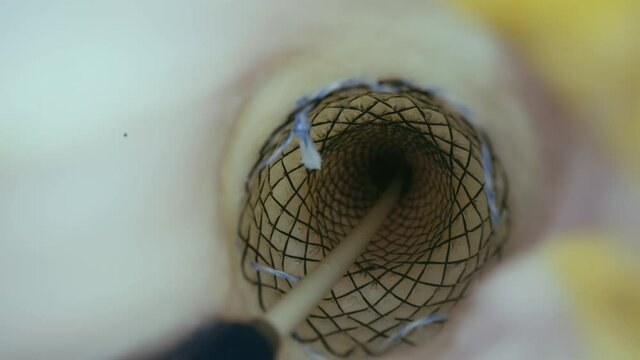 A partially covered self-expandable metallic stent.