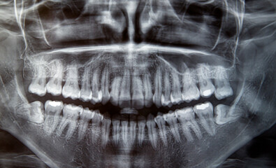 panoramic radiography of a patient's mouth - obrazy, fototapety, plakaty