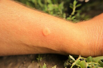 Skin allergy, allergic.
Yellow wasp : stung by a wasp worker.
Yellow hornet stings a man's...