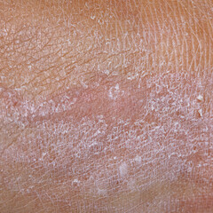 Macro of dry skin of a woman's body