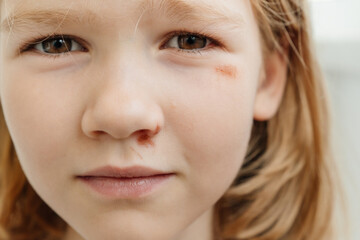 Naklejka premium Portrait girl with an abrasion under her eye. child abuse. wounds and abrasions