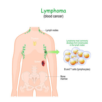 lymphoma or blood cancer