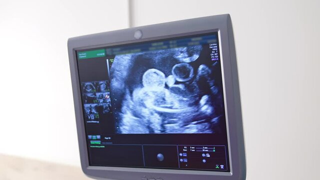Ultrasound monitor display a small baby. Panning shot of modern ultrasound machine with image of future baby on screen. Development of pregnancy.