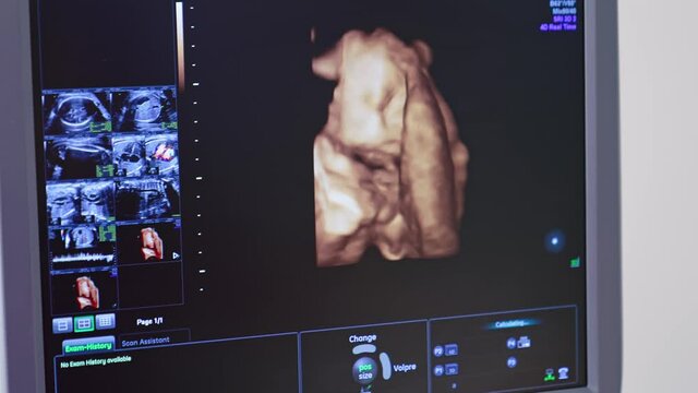 Human embryo is moving his head on an ultrasound display. Ultrasound monitor showing baby body during sonogram procedure to a pregnant woman.