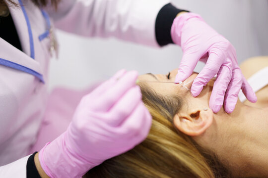 Doctor injecting PDO suture treatment threads into the face of a woman.