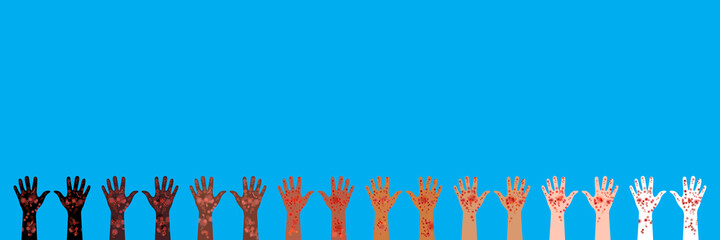 Horizontal banner. 8 pairs of hands raised up. Hands of different races and skin colors. Palms up. Painful rash covers skin. Vector illustration of skin diseases and manifestations of illness signs. - obrazy, fototapety, plakaty