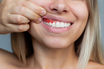 Gum inflammation. Close-up of a young woman showing bleeding gums on a gray background. Dentistry,...