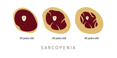 Sarcopenia in elderly. Replacement of muscle tissue - 453630391