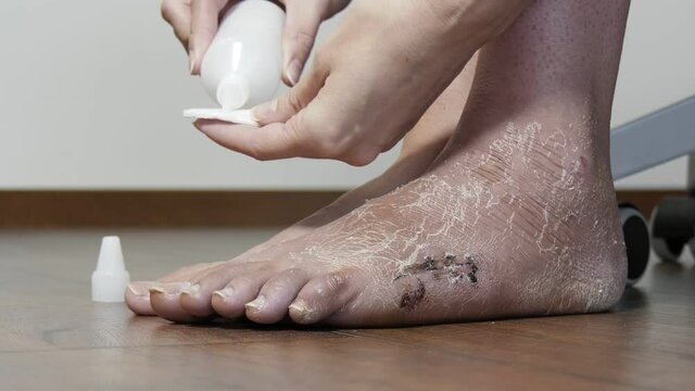A woman treats a scar with a bactericidal agent after surgery. Postoperative suture on the foot, leg after fracture and after removal of plaster bandage.