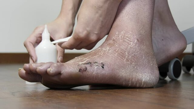 A woman treats a scar with a bactericidal agent after surgery. Postoperative suture on the foot, leg after fracture and after removal of plaster bandage.