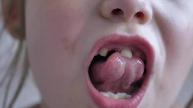 Kid with open mouth touches upper middle tooth with tongue and lost tooth hole nearby at dentist extreme closeup body part