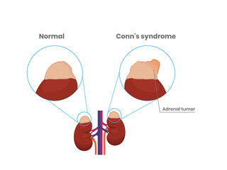 Adrenal gland normal anatomy and adrenal adenoma illustration
