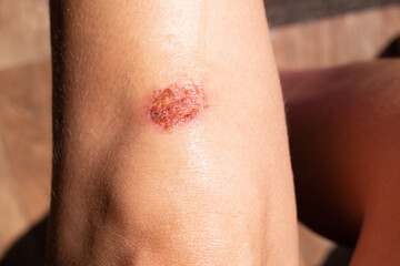 A wound on a woman's knee after a blow, a fall. Trauma treatment and care
