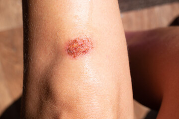 Fototapeta premium A wound on a woman's knee after a blow, a fall. Trauma treatment and care