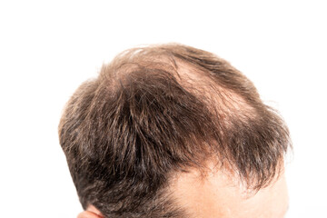 Close-up balding head of a young man on a white isolated background.
