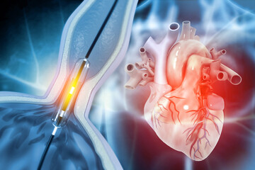 Human heart with Balloon angioplasty. 3d illustration