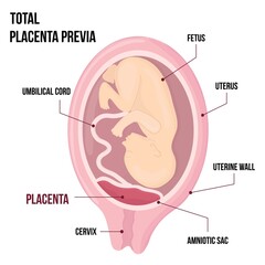 Total Placental previa. Dangerous Placenta Location During Pregnancy. Medical Pathology. detailed medical diagram with table of symbols.