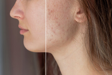 Cropped shot of a young woman's face before and after acne treatment on face. Pimples, red scars, rash on cheeks and chin. Allergies, dermatitis, bad nutrition. Problem skin, health care