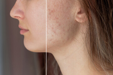 Cropped shot of a young woman's face before and after acne treatment on face. Pimples, red scars,...