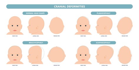 craniosynostosis helmet pillow flat head autism brain skull bone deformity baby infant child newborn defect birth anterior Metopic Born genes genetic position sleep shape deformation tummy time  - obrazy, fototapety, plakaty